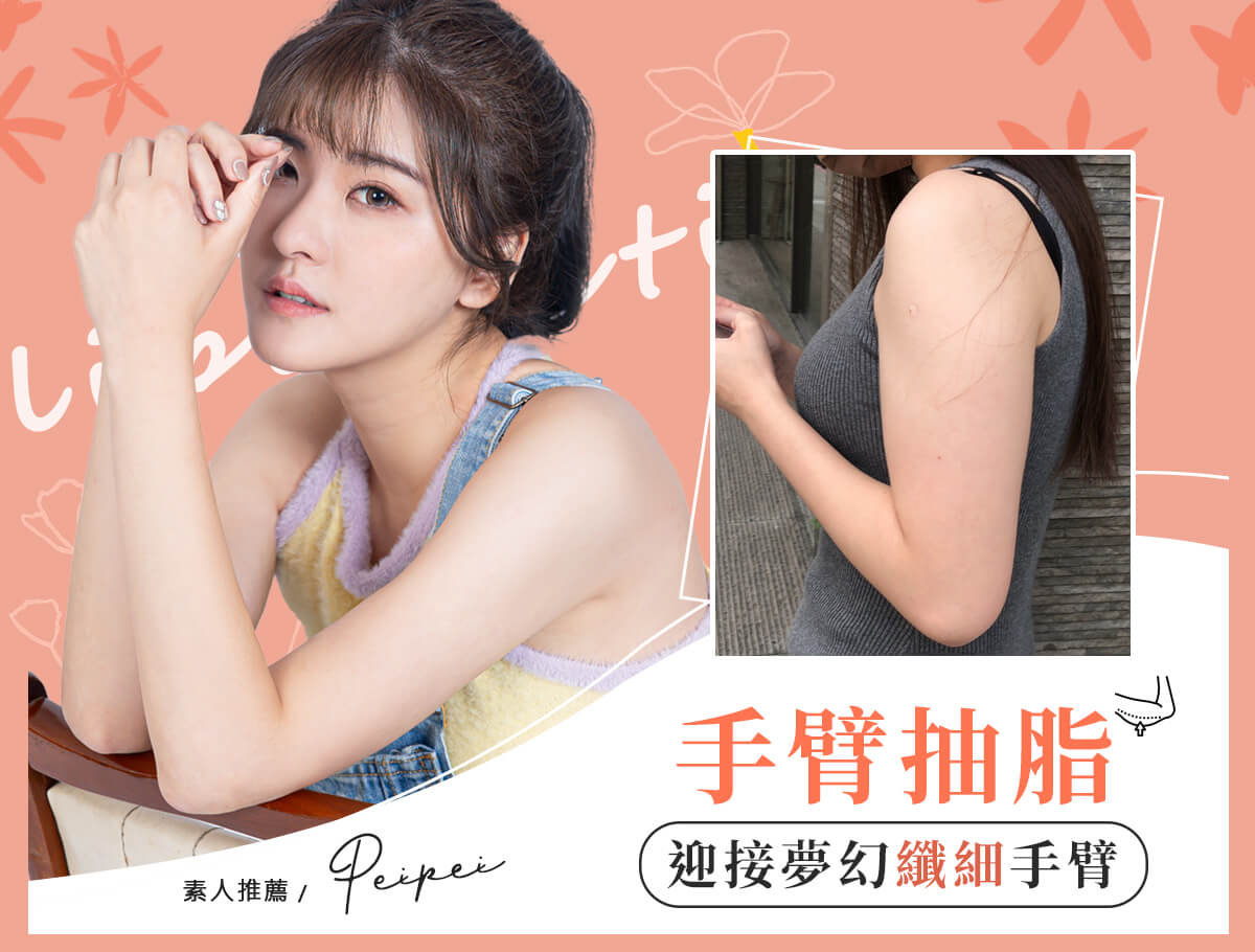 手臂抽脂手術_案例封面