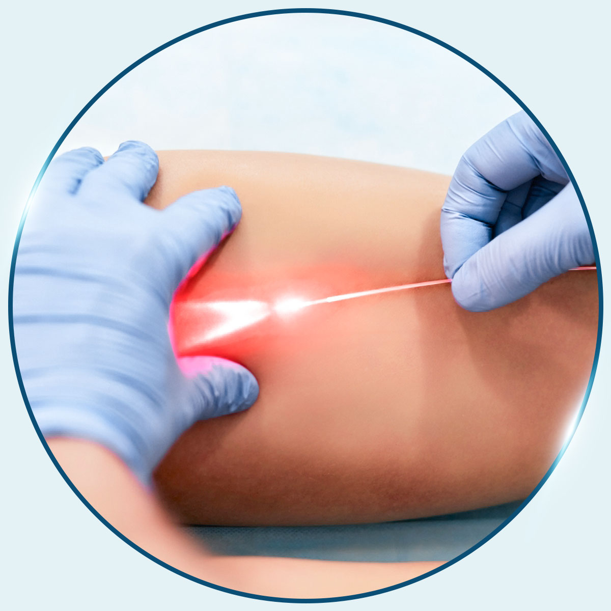 抽脂手術_靜脈雷射