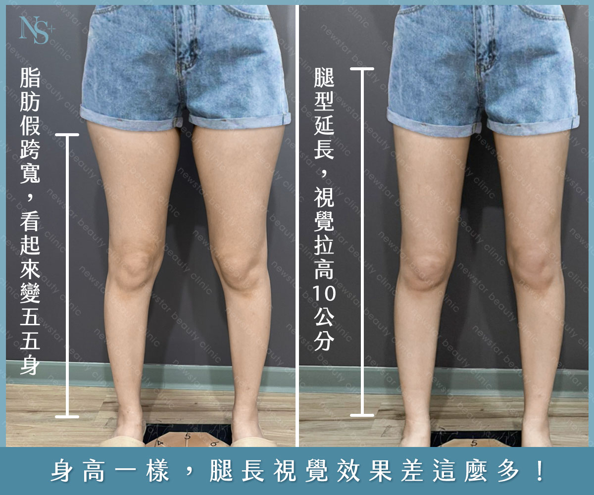 威塑抽脂解決假胯寬問題