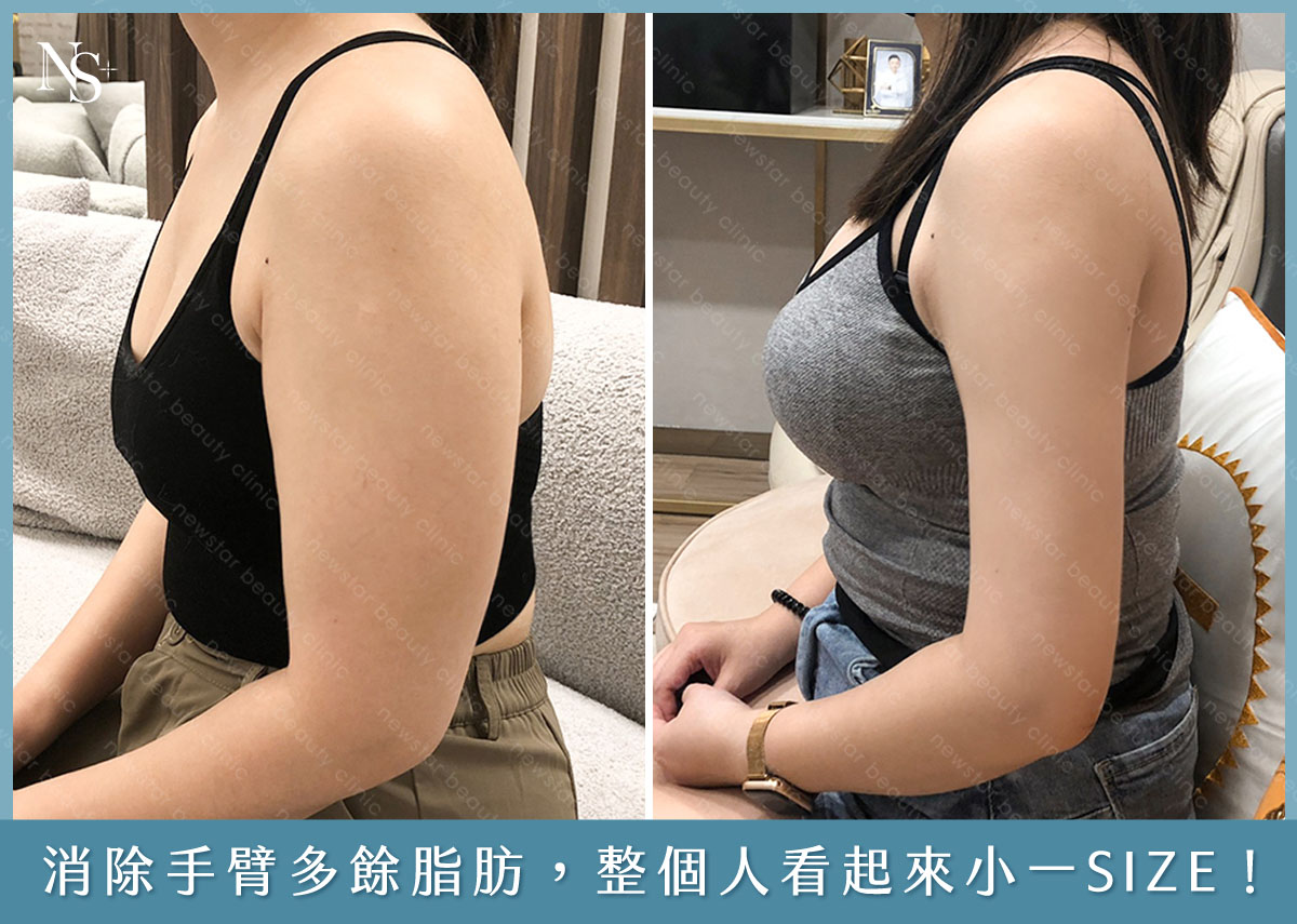 威塑抽脂消除蝴蝶袖