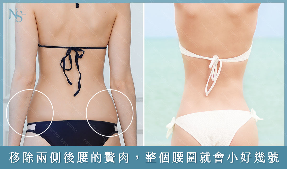 威塑抽脂消滅腰間肉