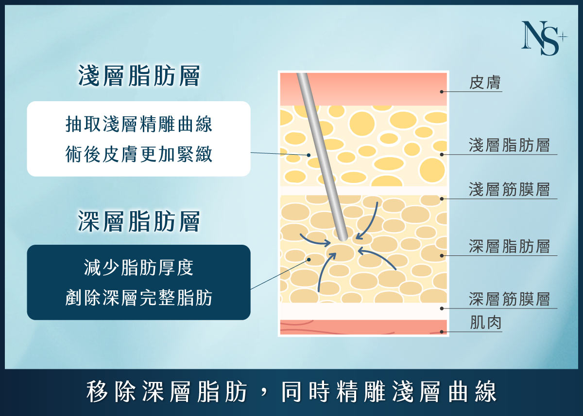 威塑抽脂_深層抽脂-淺層精雕