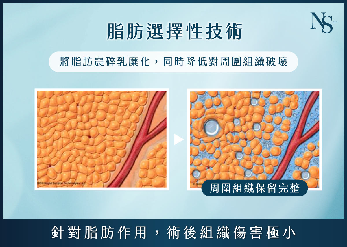 威塑抽脂_術後緊緻不鬆弛