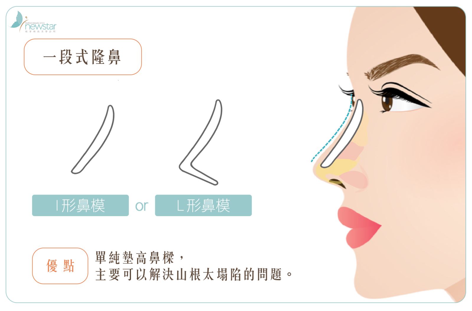 隆鼻手術 - 欣莘時尚美學診所