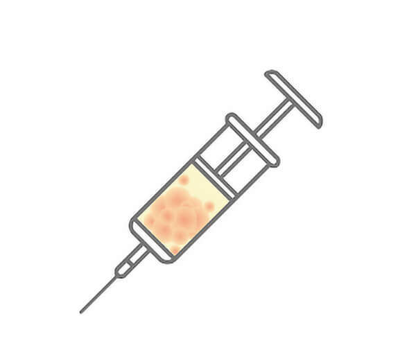 自體脂肪隆乳步驟3：回填至胸部