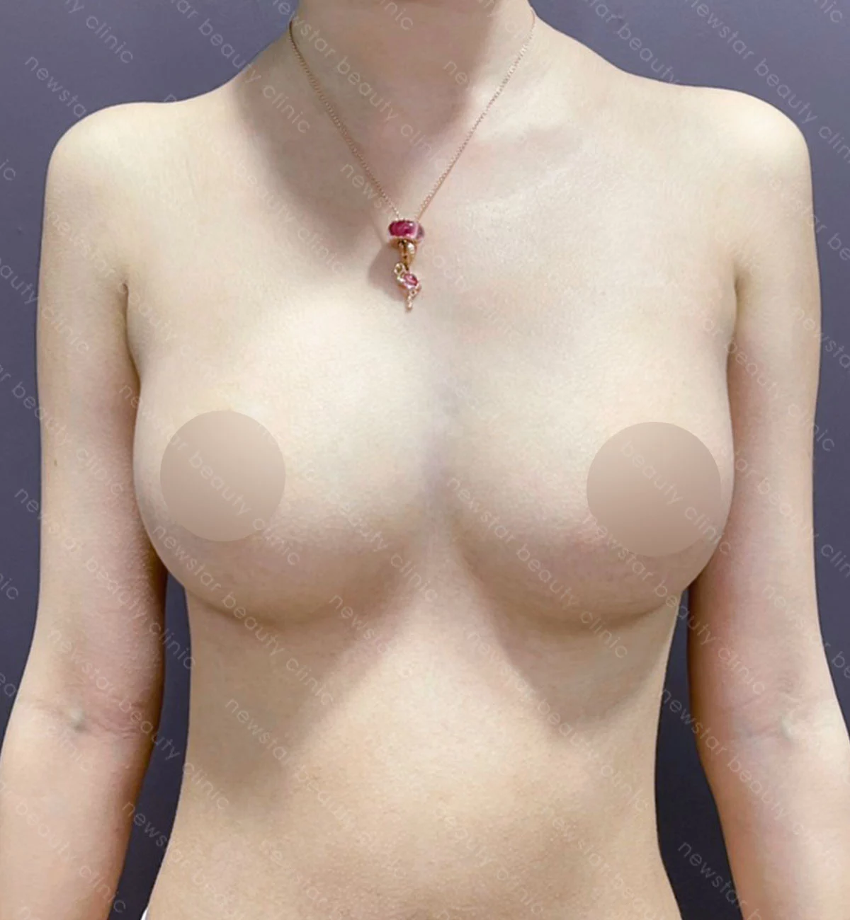 自體隆乳+大腿抽脂案例_KT_BA_胸部術後(正面)