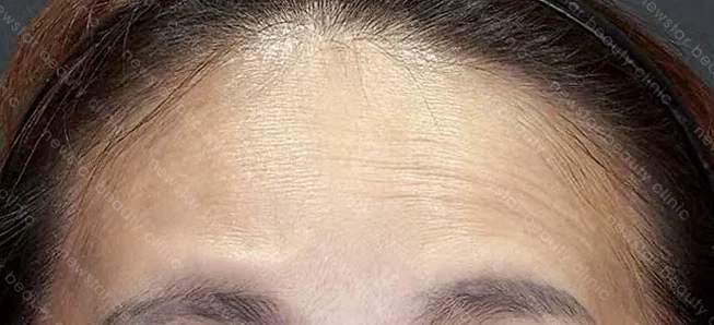 肉毒案例_抬頭紋_術前