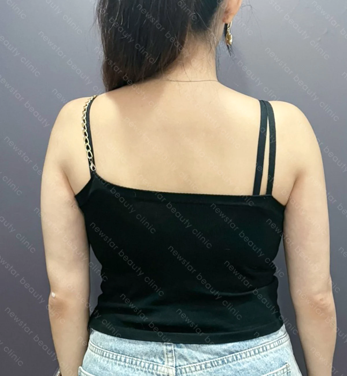 手臂抽脂案例_果凍_after(正背面)