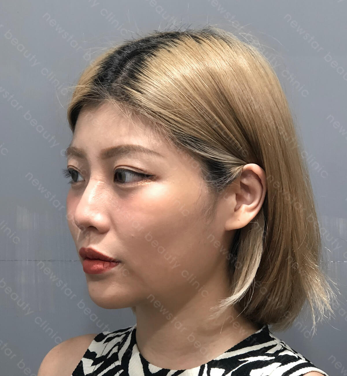 Q+音波_術前案例