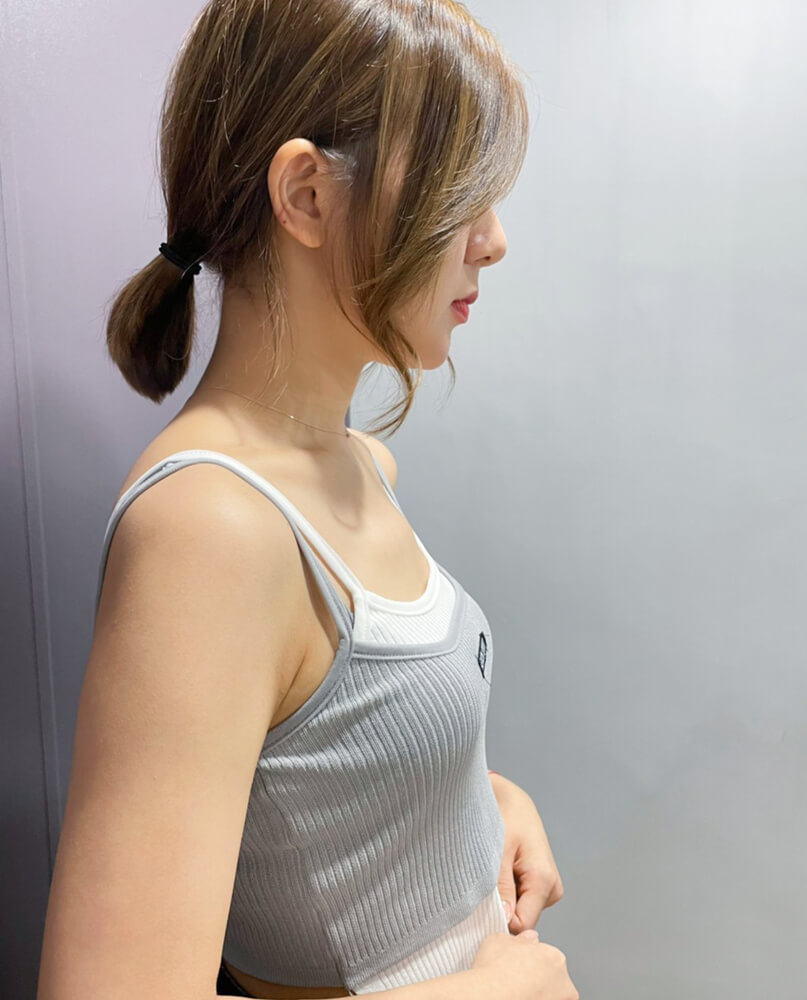自體脂肪隆乳_術前