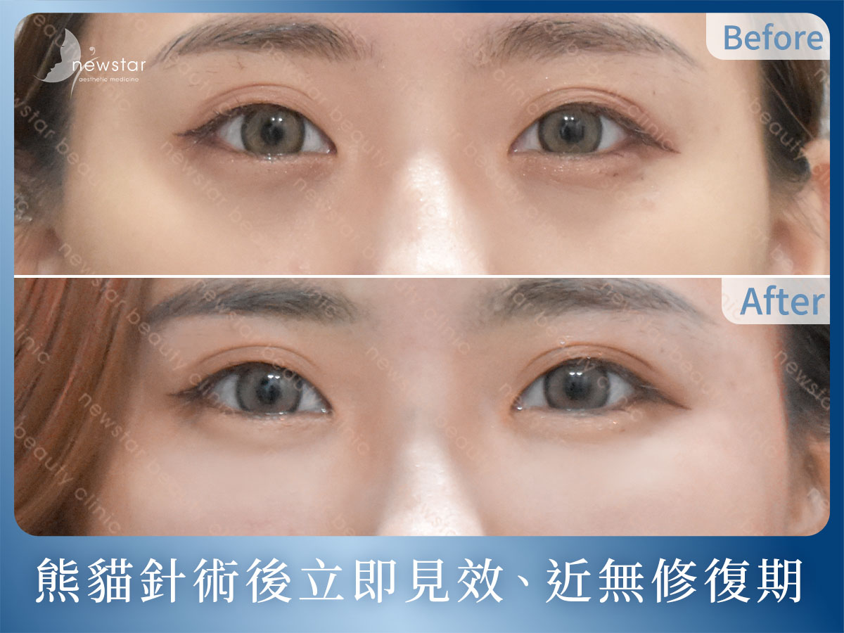 膠原蛋白熊貓針_效果立即