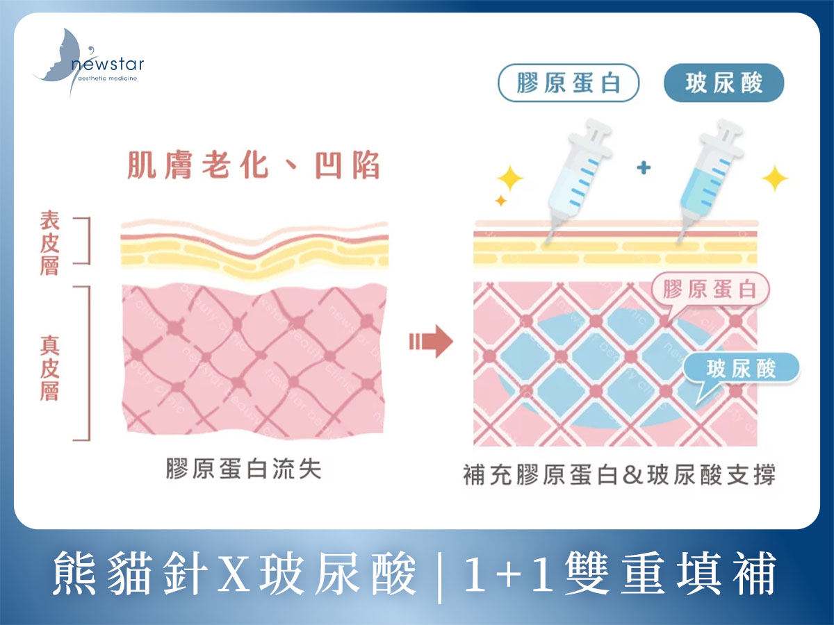 膠原蛋白熊貓針_五大優勢_熊貓針+玻尿酸