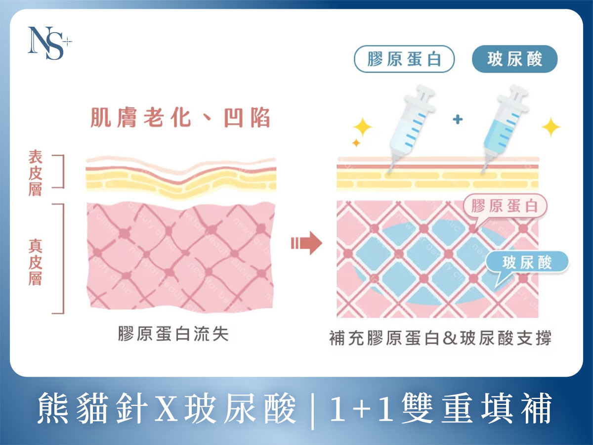膠原蛋白熊貓針_五大優勢_熊貓針+玻尿酸