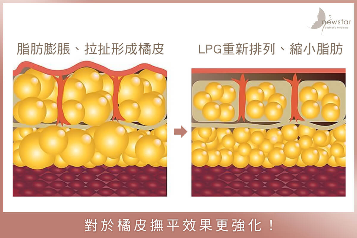 LPG體雕_探頭升級