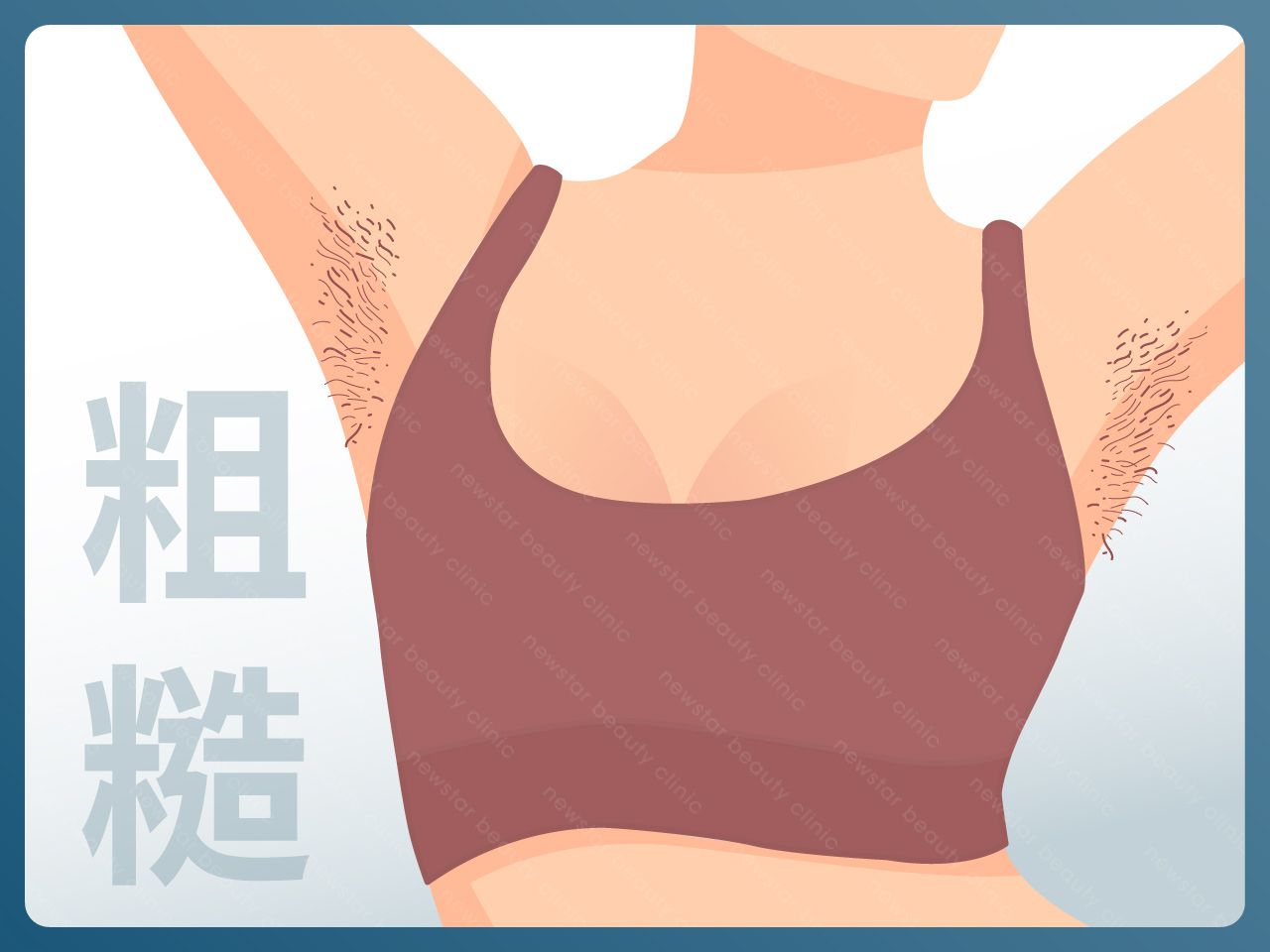海神除毛_毛粗糙