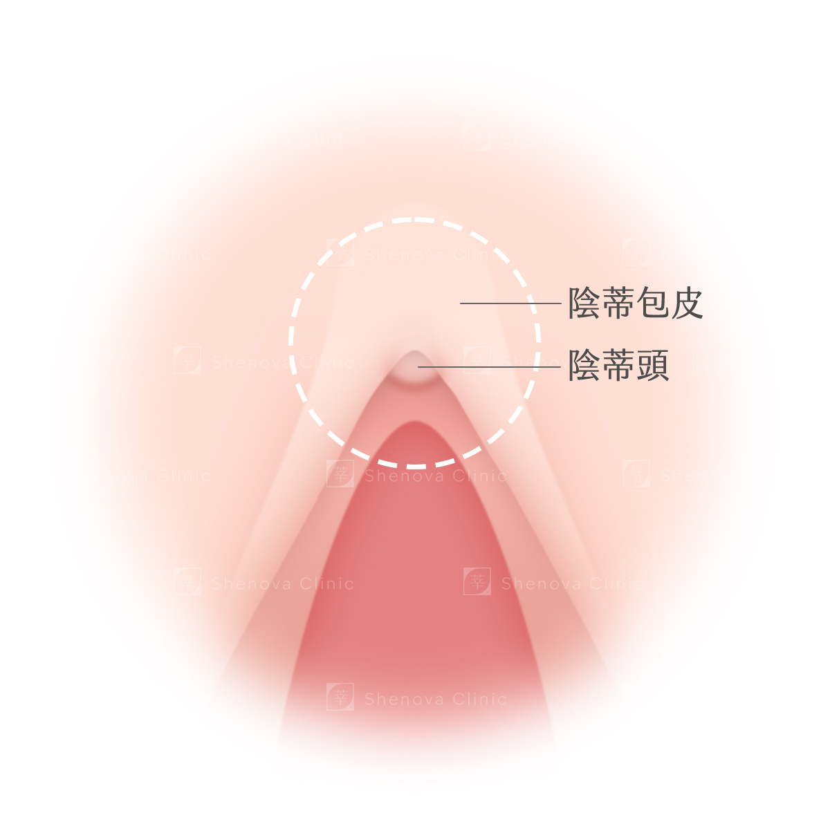 私密處手術_包皮覆蓋