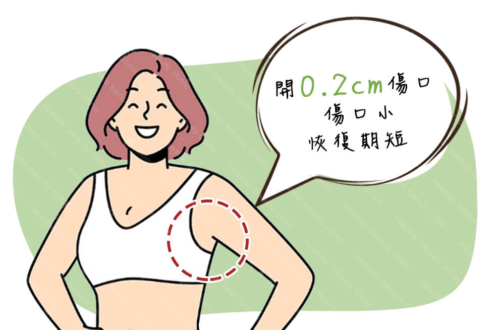 自體脂肪隆乳優點：傷口小、恢復期短