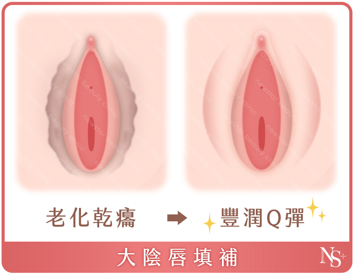 私密處手術_大陰唇填補