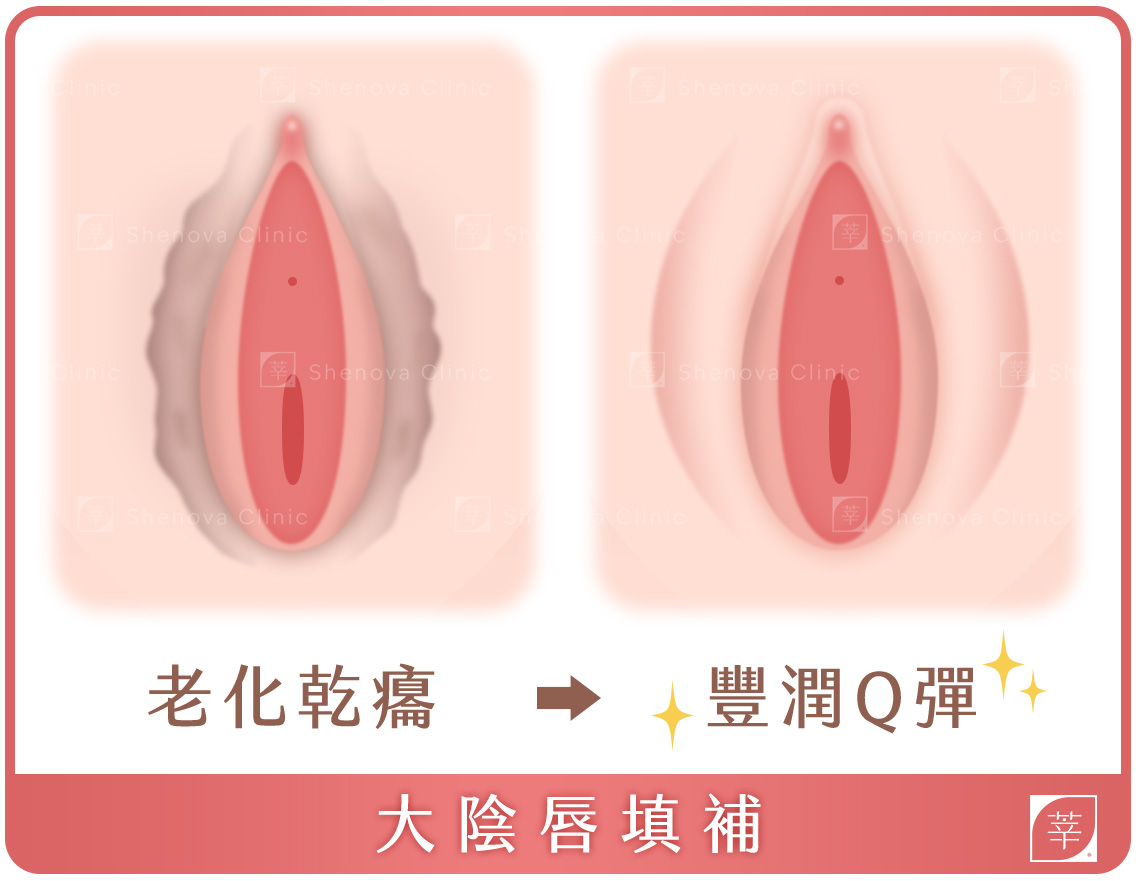 私密處手術_大陰唇填補