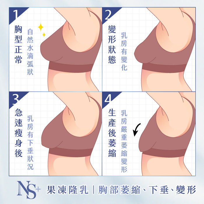 腹部拉皮手術｜果凍隆乳