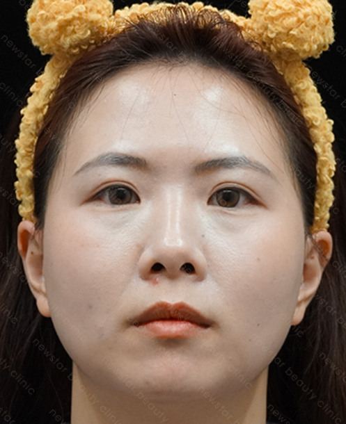 欣莘案例_Q+音波_術前