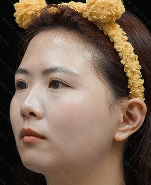 欣莘案例_Q+音波_術前