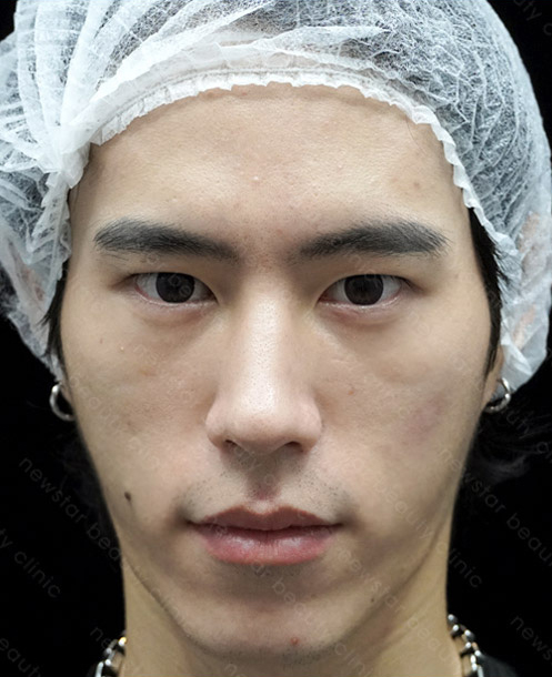 欣莘案例_Q+音波_術前