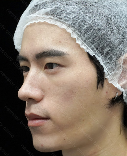 欣莘案例_Q+音波_術前