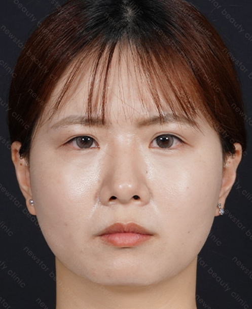 欣莘案例_Q+音波_術後