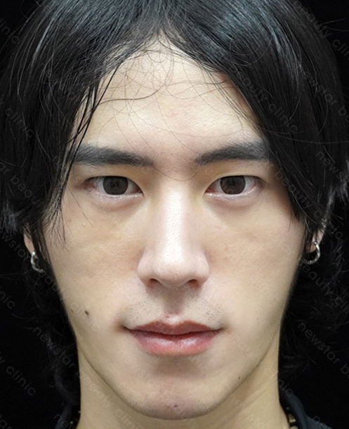 欣莘案例_Q+音波_術後