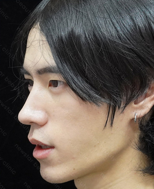 欣莘案例_Q+音波_術後