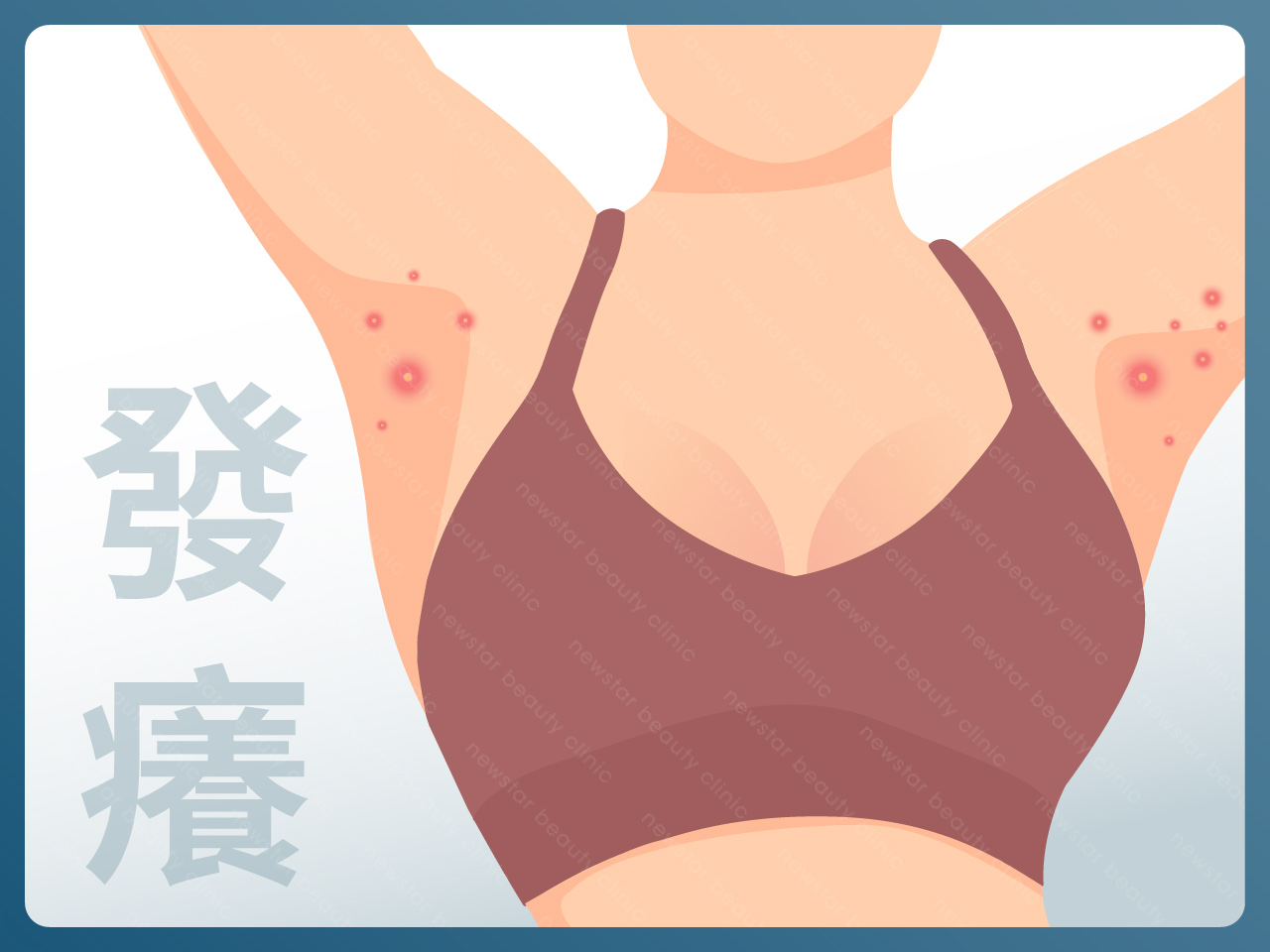 海神除毛_毛囊炎