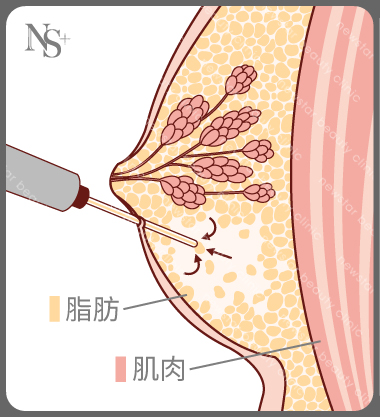 男性女乳症_手術方式_抽出多餘脂肪