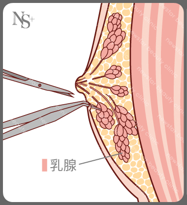 男性女乳症_手術方式_乳腺組織切除