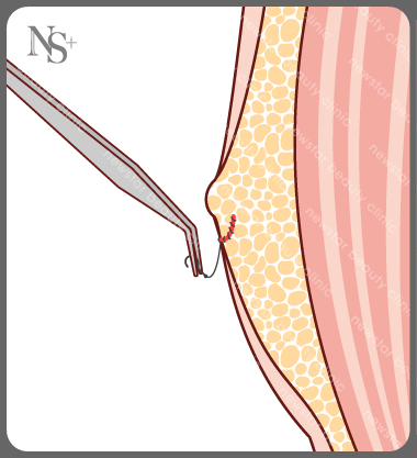 男性女乳症_手術方式_拉皮緊緻胸部