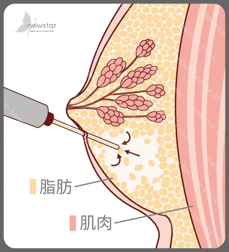 男性女乳症_手術方式_抽出多餘脂肪