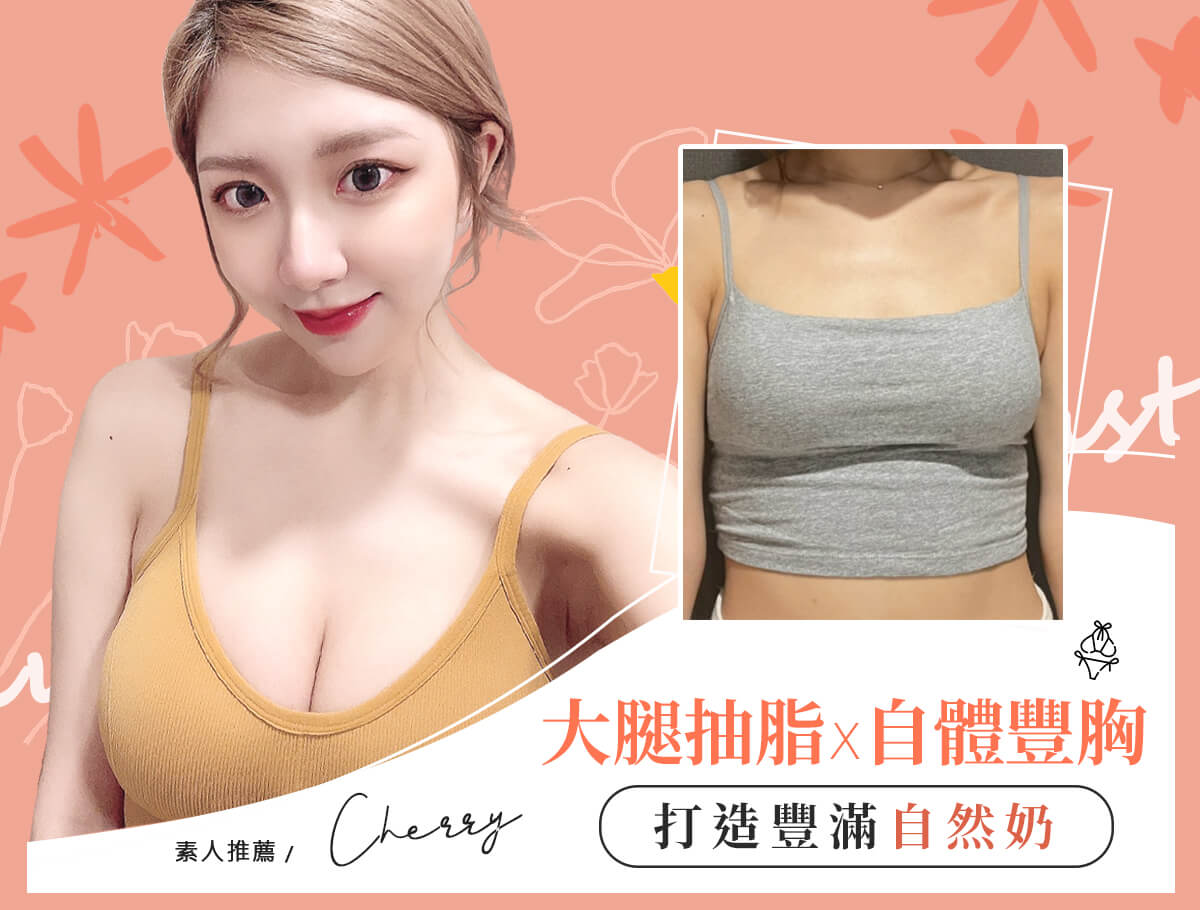 自體脂肪豐胸手術_案例封面