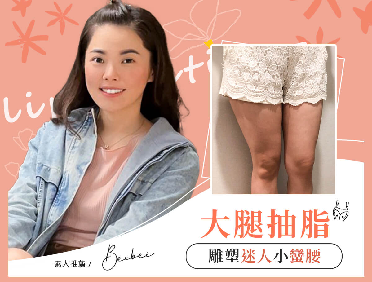 大腿抽脂手術_案例