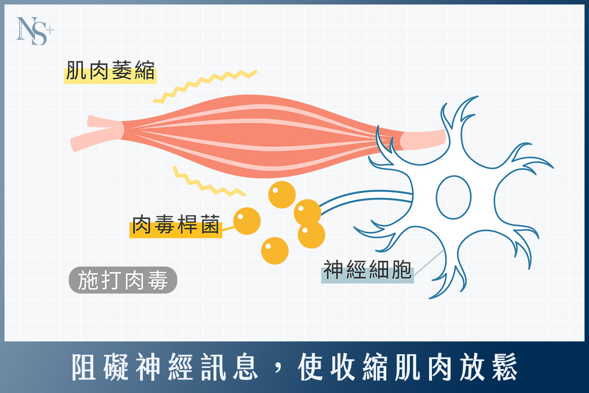 肉毒瘦小臉_肉毒桿菌是甚麼