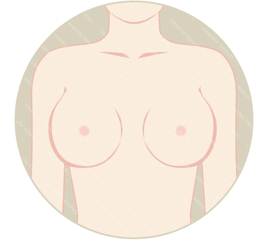 自體脂肪隆乳_改善假體隆乳邊緣感