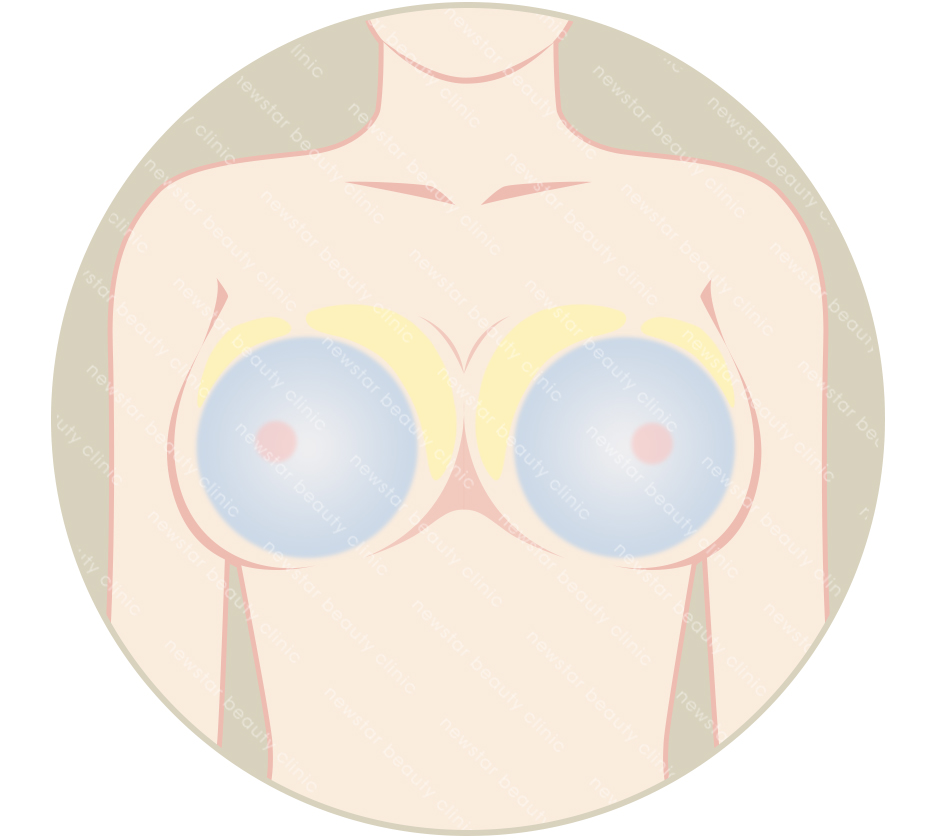 自體脂肪隆乳_欲自體脂肪+假體隆乳合併進行