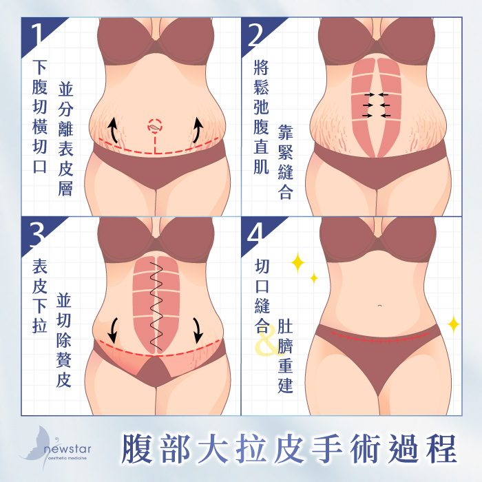 腹部拉皮手術|腹部大拉皮_手術過程