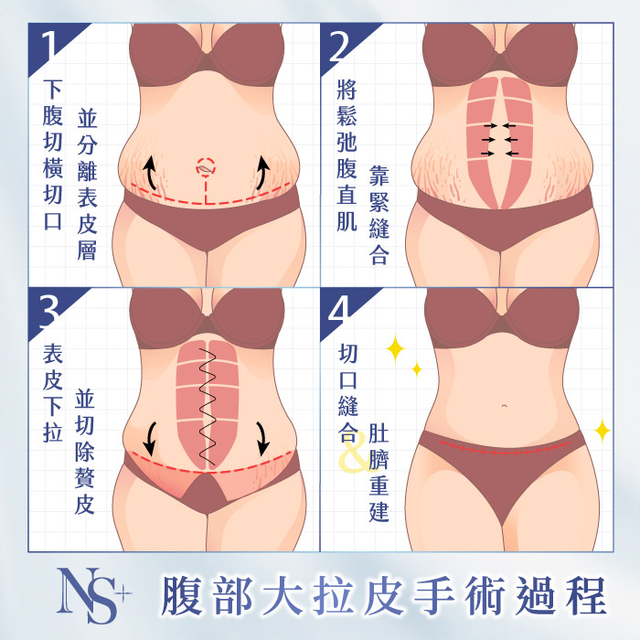 腹部拉皮手術｜腹部大拉皮_手術過程