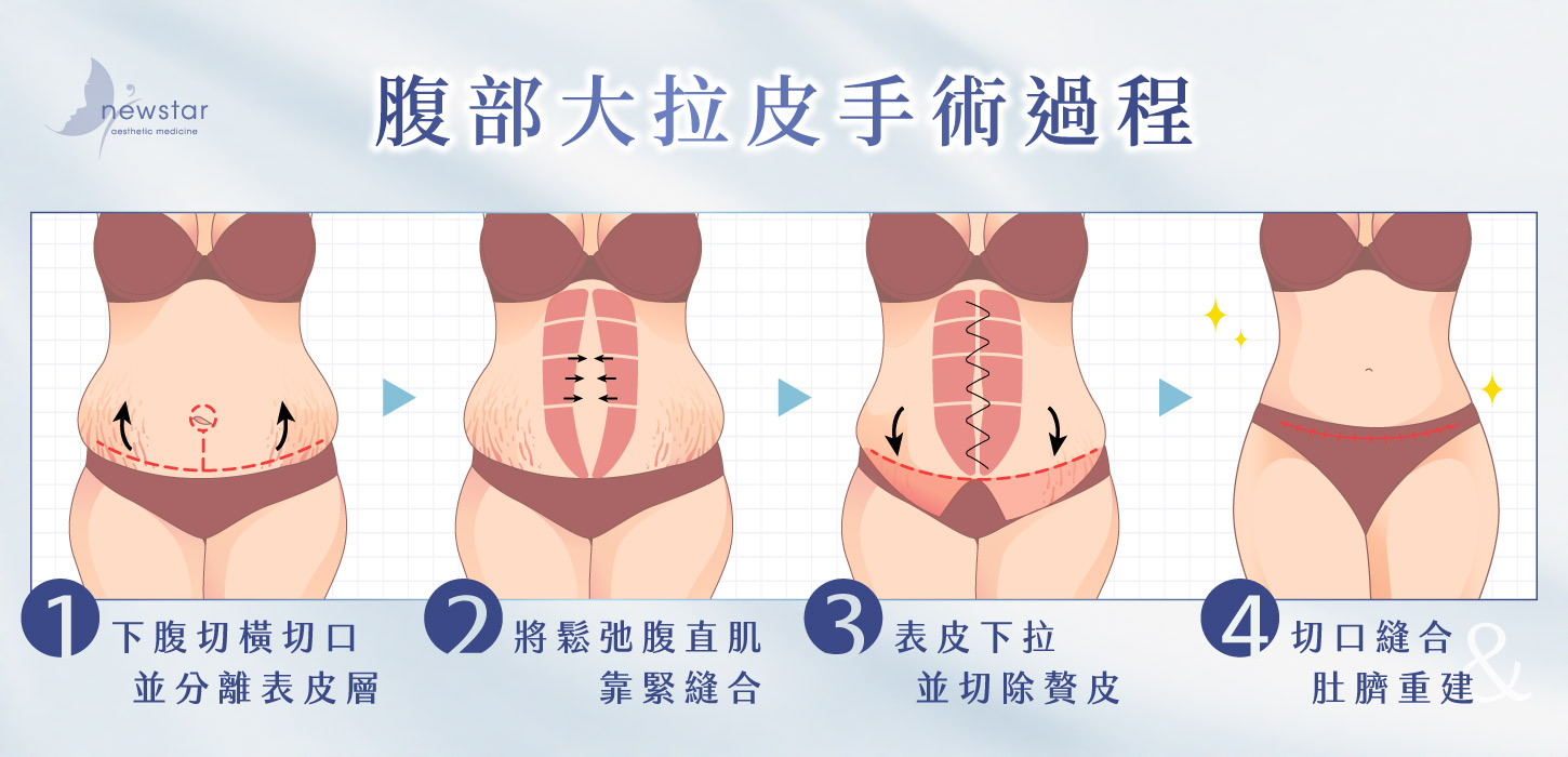 腹部拉皮手術|腹部大拉皮_手術過程