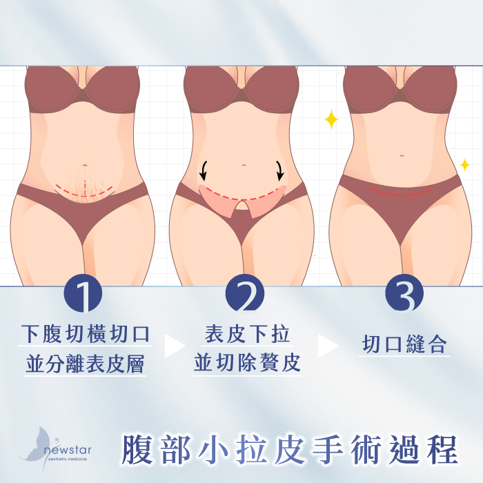 腹部拉皮手術|腹部小拉皮_手術過程
