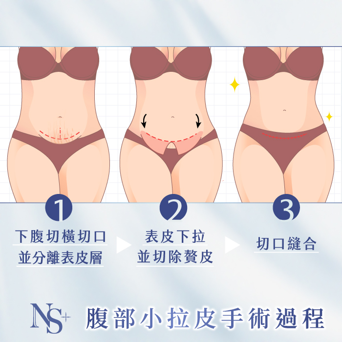 腹部拉皮手術｜腹部小拉皮_手術過程