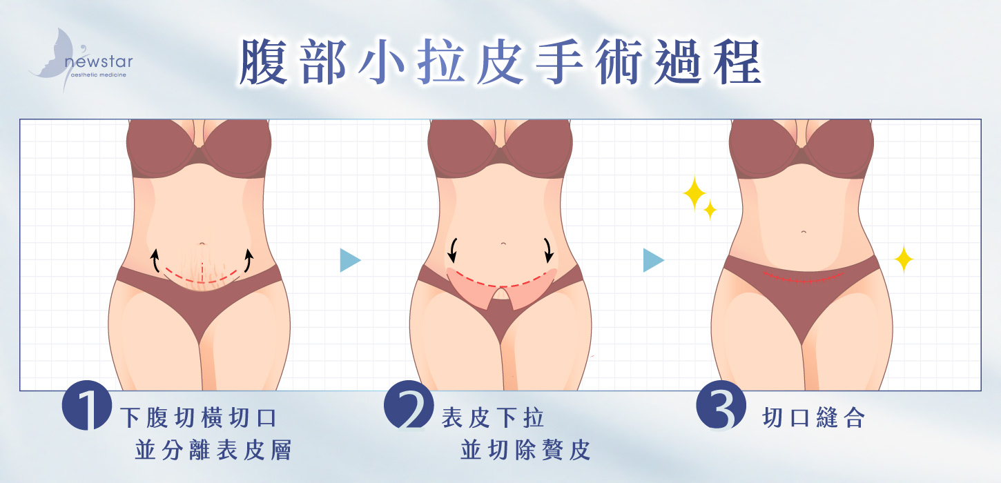 腹部拉皮手術|腹部小拉皮_手術過程