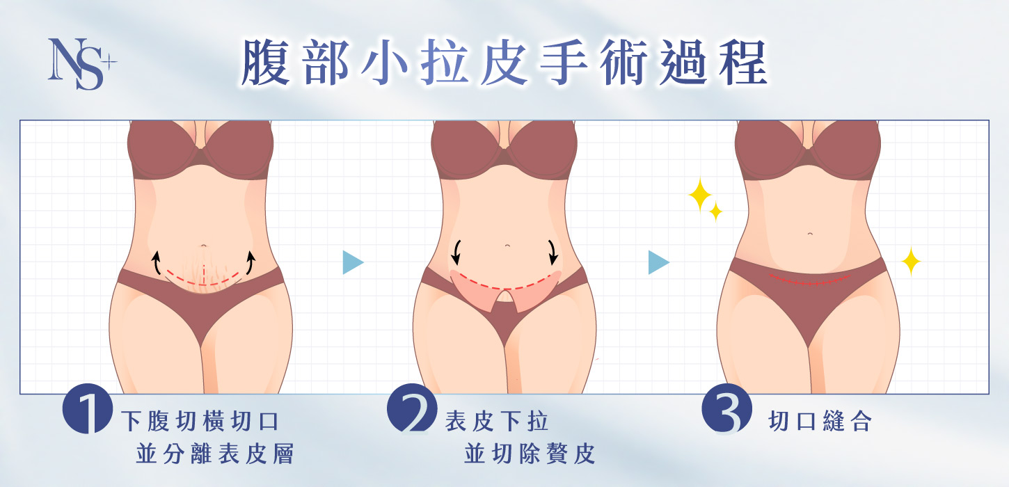 腹部拉皮手術｜腹部小拉皮_手術過程