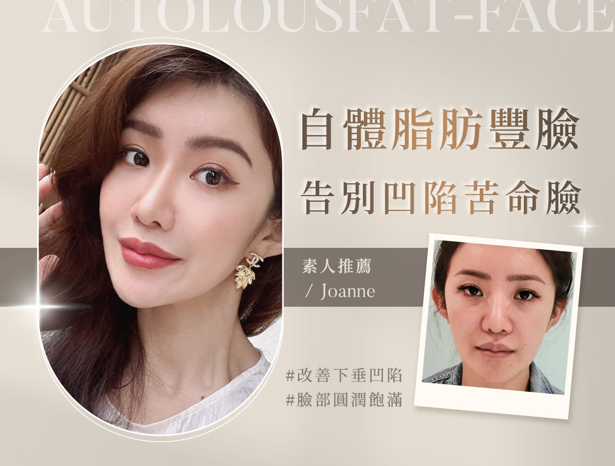 自體脂肪補臉_外bn_joanne1