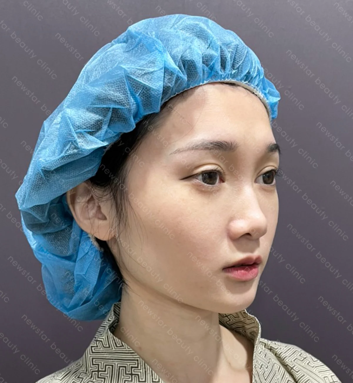 自體脂肪豐臉_案例_術前(側面)